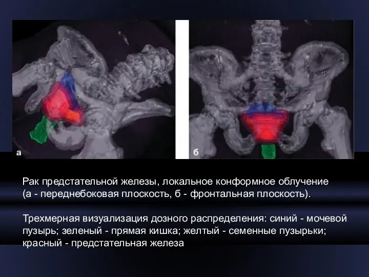 Рак предстательной железы, локальное конформное облучение (а - переднебоковая плоскость,