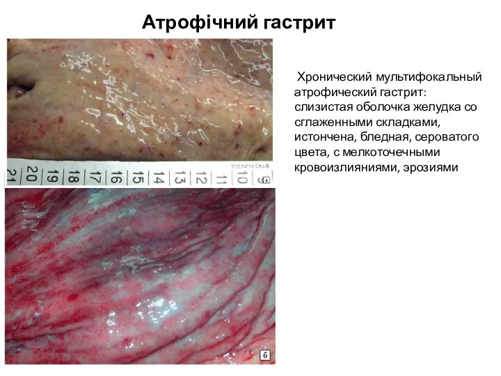 Атрофічний гастрит Хронический мультифокальный атрофический гастрит: слизистая оболочка желудка со