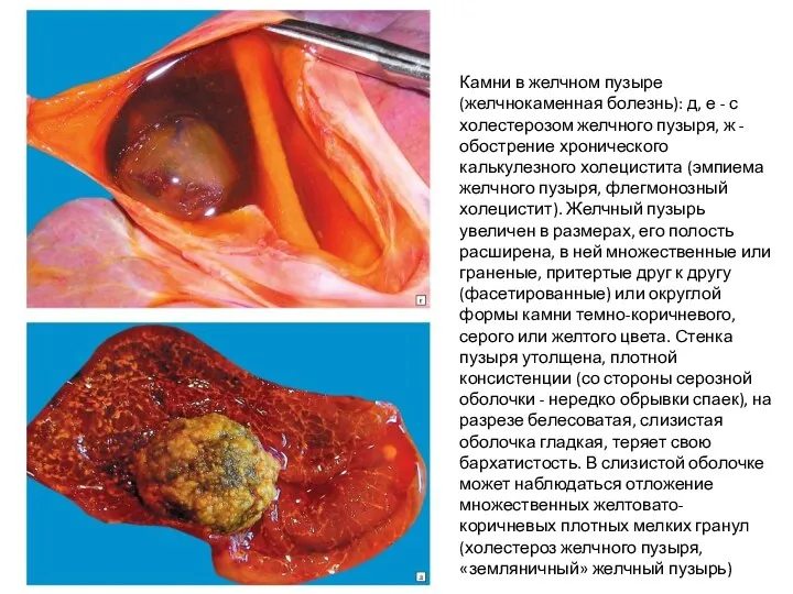 Камни в желчном пузыре (желчнокаменная болезнь): д, е - с