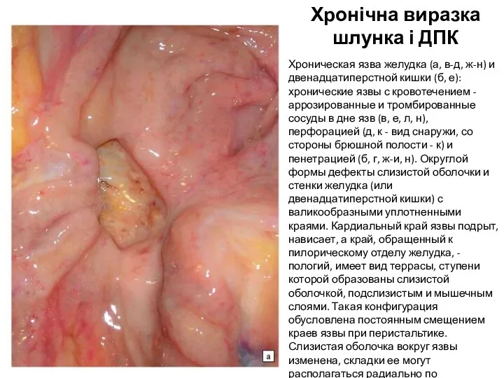Хронічна виразка шлунка і ДПК Хроническая язва желудка (а, в-д,