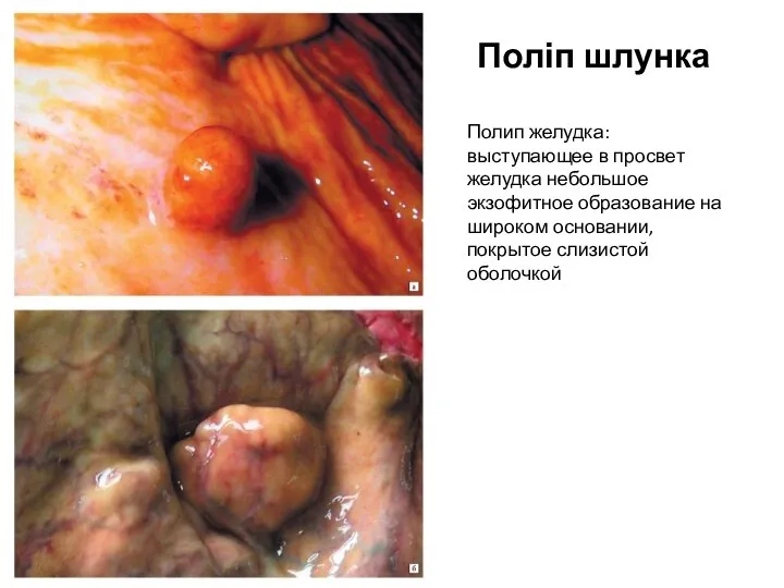 Поліп шлунка Полип желудка: выступающее в просвет желудка небольшое экзофитное
