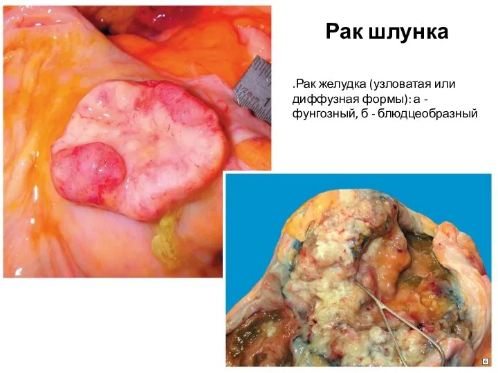 Рак шлунка .Рак желудка (узловатая или диффузная формы): а - фунгозный, б - блюдцеобразный
