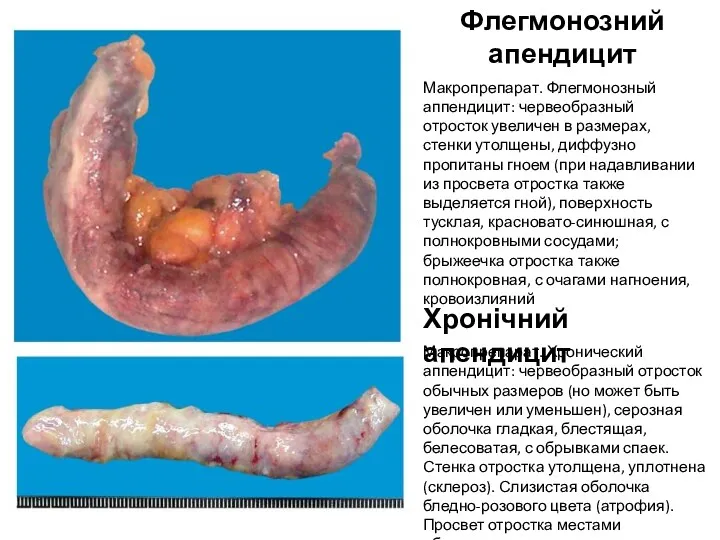 Флегмонозний апендицит Макропрепарат. Флегмонозный аппендицит: червеобразный отросток увеличен в размерах,