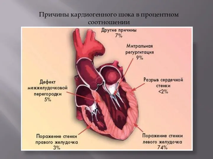 Причины кардиогенного шока в процентном соотношении