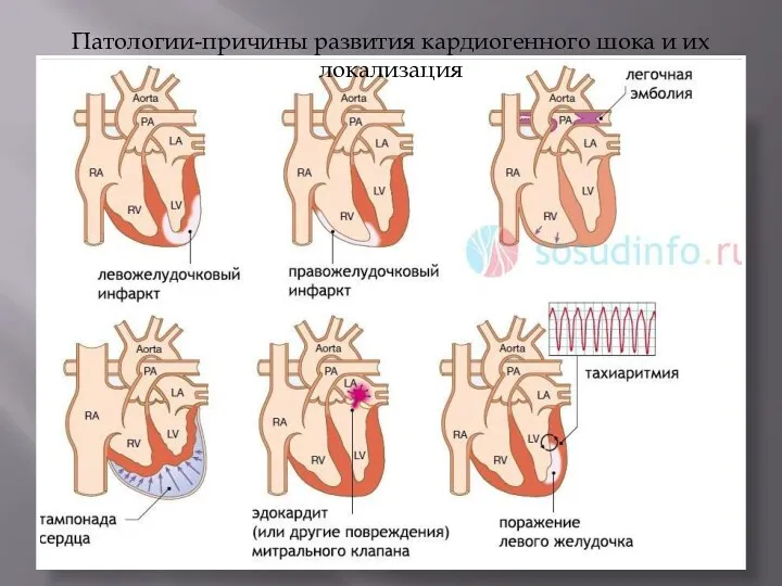 Патологии-причины развития кардиогенного шока и их локализация