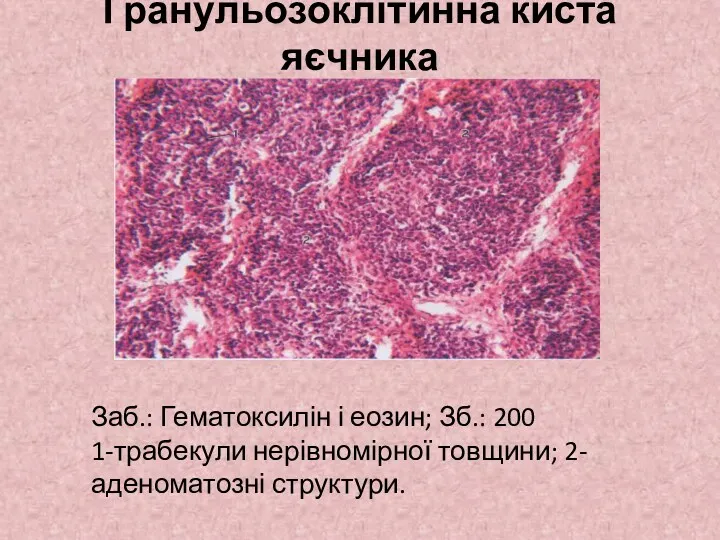 Гранульозоклітинна киста яєчника Заб.: Гематоксилін і еозин; Зб.: 200 1-трабекули нерівномірної товщини; 2-аденоматозні структури.