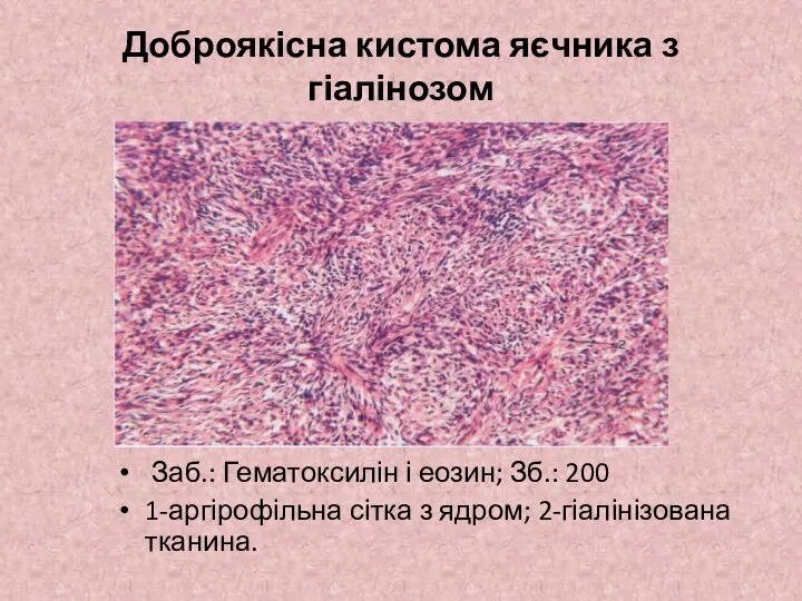 Доброякісна кистома яєчника з гіалінозом Заб.: Гематоксилін і еозин; Зб.: