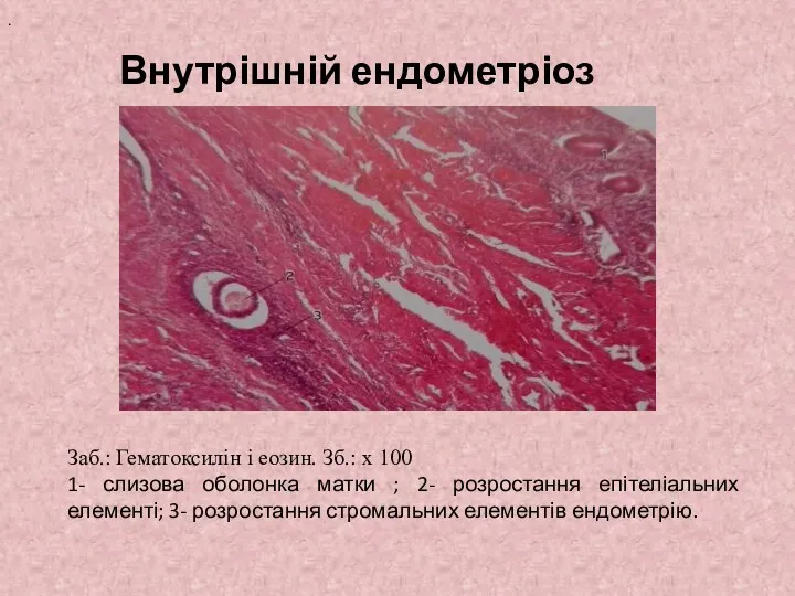 Внутрішній ендометріоз Заб.: Гематоксилін і еозин. Зб.: х 100 1-