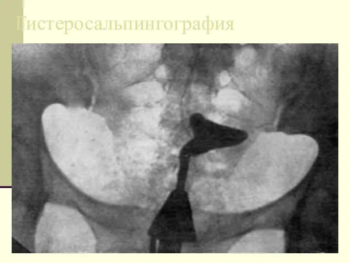 Гистеросальпингография