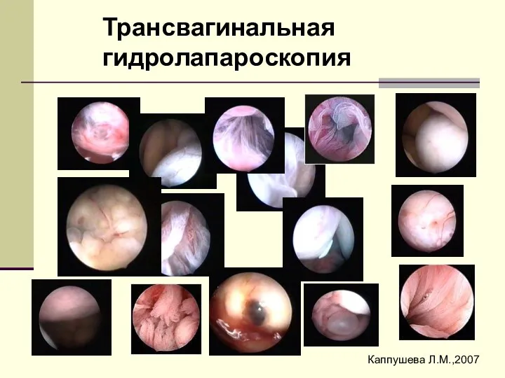 Трансвагинальная гидролапароскопия Каппушева Л.М.,2007