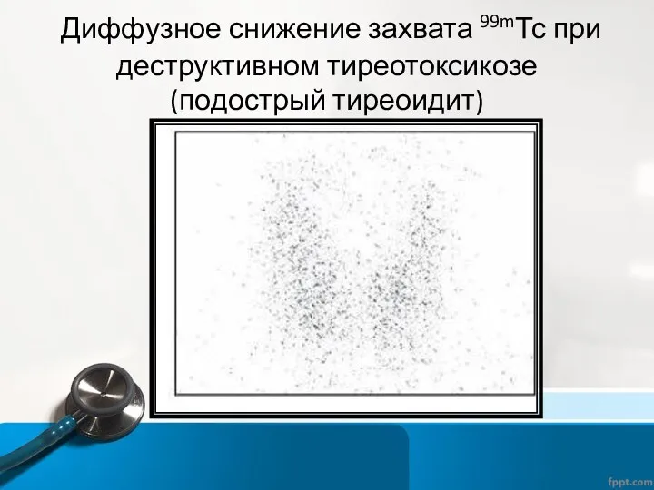 Диффузное снижение захвата 99mТс при деструктивном тиреотоксикозе (подострый тиреоидит)