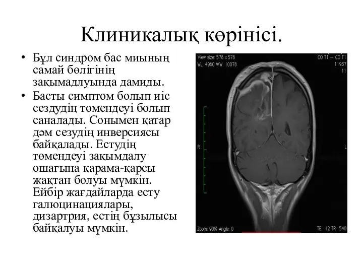 Клиникалық көрінісі. Бұл синдром бас миының самай бөлігінің зақымадлуында дамиды.