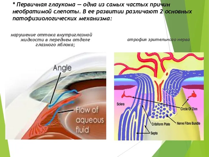 * Первичная глаукома — одна из самых частых причин необратимой