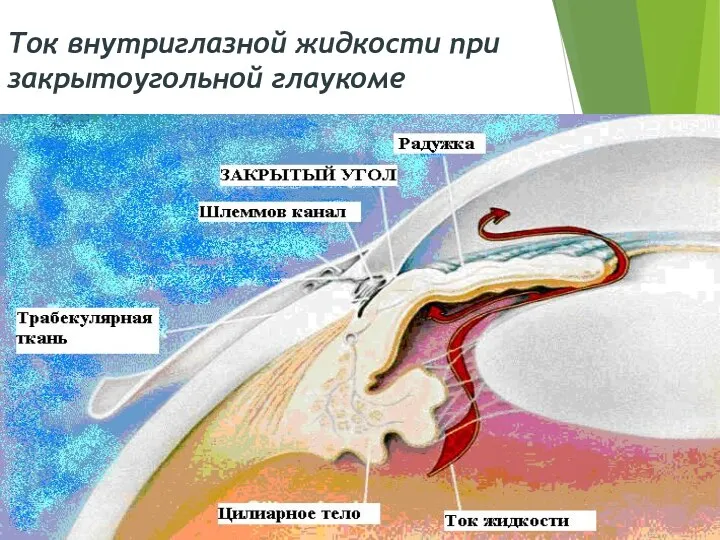 Ток внутриглазной жидкости при закрытоугольной глаукоме