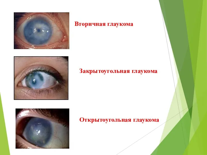 Вторичная глаукома Закрытоугольная глаукома Открытоугольная глаукома