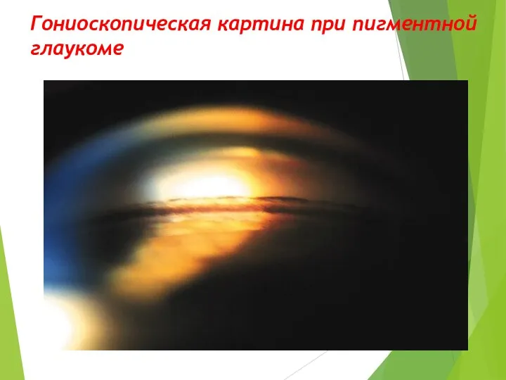 Гониоскопическая картина при пигментной глаукоме