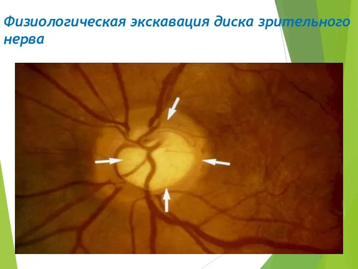 Физиологическая экскавация диска зрительного нерва