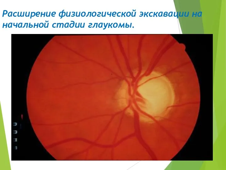 Расширение физиологической экскавации на начальной стадии глаукомы.