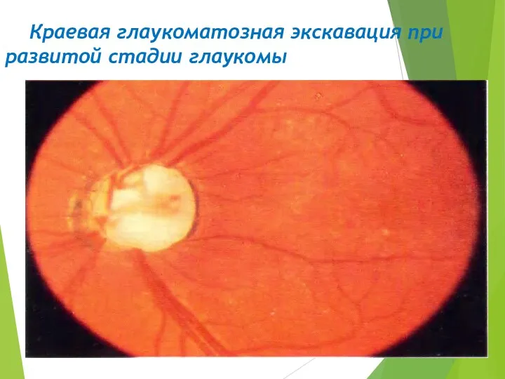 Краевая глаукоматозная экскавация при развитой стадии глаукомы