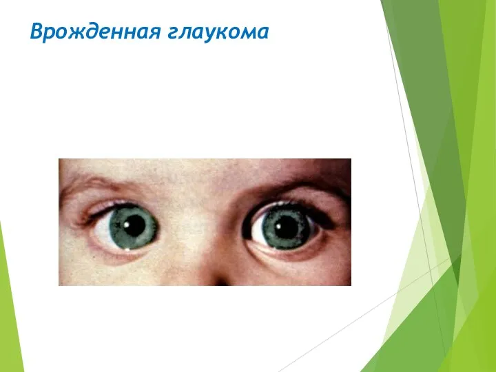 Врожденная глаукома