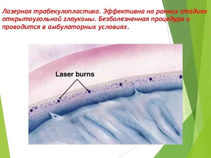 Лазерная трабекулопластика. Эффективна на ранних стадиях открытоугольной глаукомы. Безболезненная процедура и проводится в амбулаторных условиях.