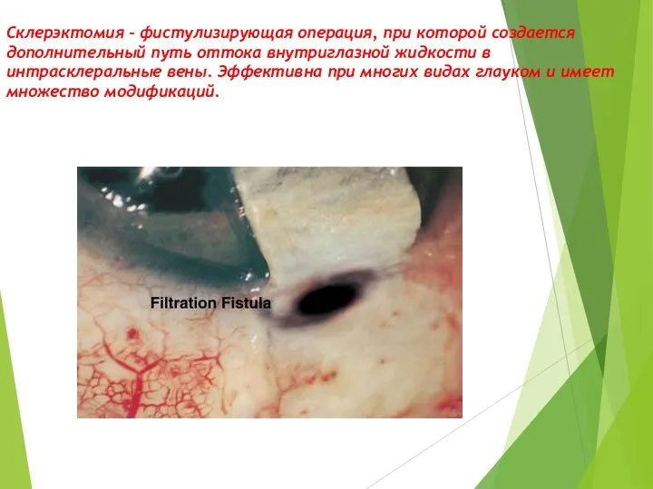 Склерэктомия – фистулизирующая операция, при которой создается дополнительный путь оттока