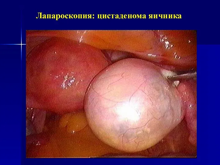 Лапароскопия: цистаденома яичника