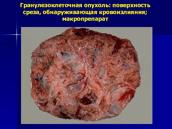 Гранулезоклеточная опухоль: поверхность среза, обнаруживающая кровоизлияния; макропрепарат