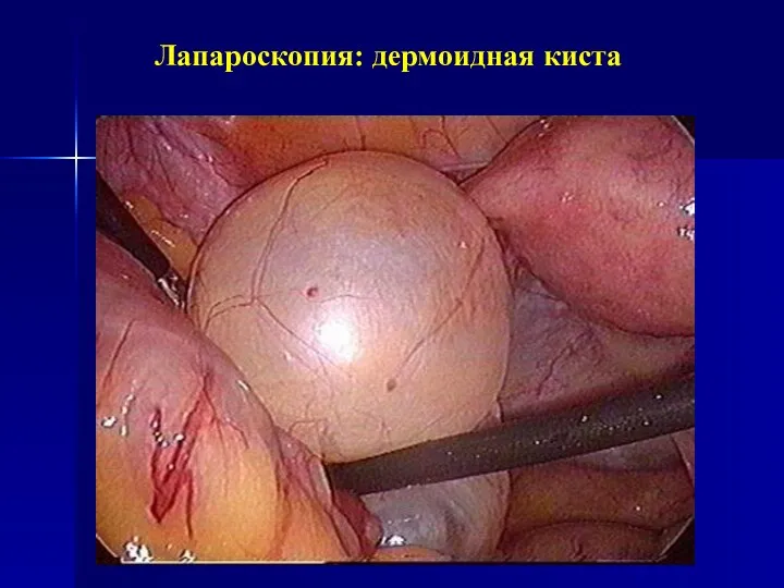 Лапароскопия: дермоидная киста
