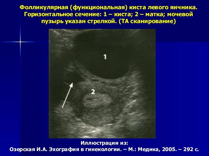 Иллюстрации из: Озерская И.А. Эхография в гинекологии. – М.: Медика, 2005. – 292