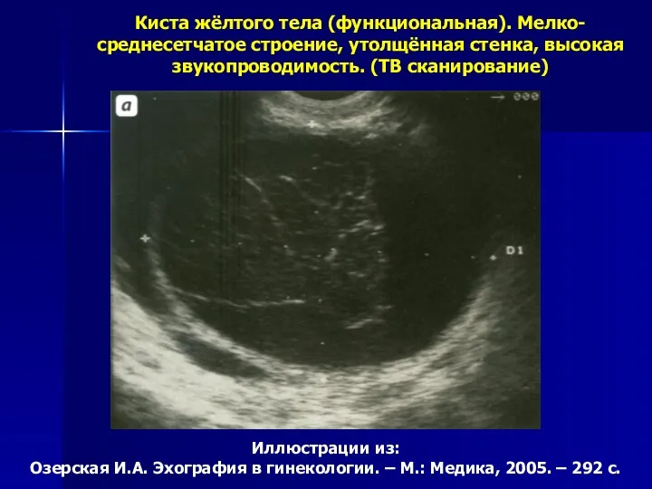 Иллюстрации из: Озерская И.А. Эхография в гинекологии. – М.: Медика, 2005. – 292