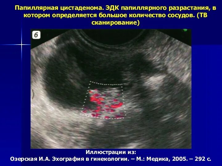 Иллюстрации из: Озерская И.А. Эхография в гинекологии. – М.: Медика, 2005. – 292