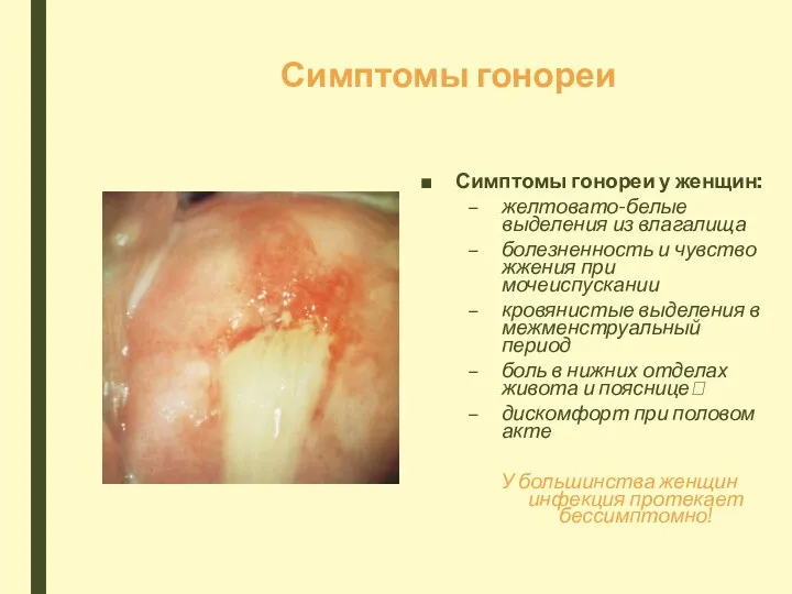 Симптомы гонореи Симптомы гонореи у женщин: желтовато-белые выделения из влагалища