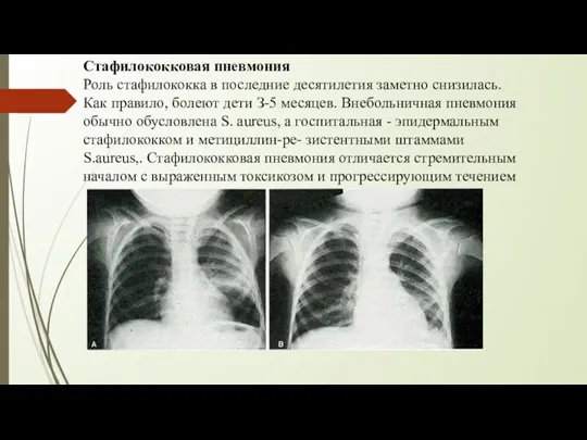 Стафилококковая пневмония Роль стафилококка в последние десятилетия заметно снизилась. Как