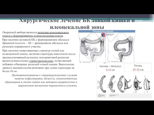 Хирургическое лечение БК тонкой кишки и илеоцекальной зоны Операцией выбора