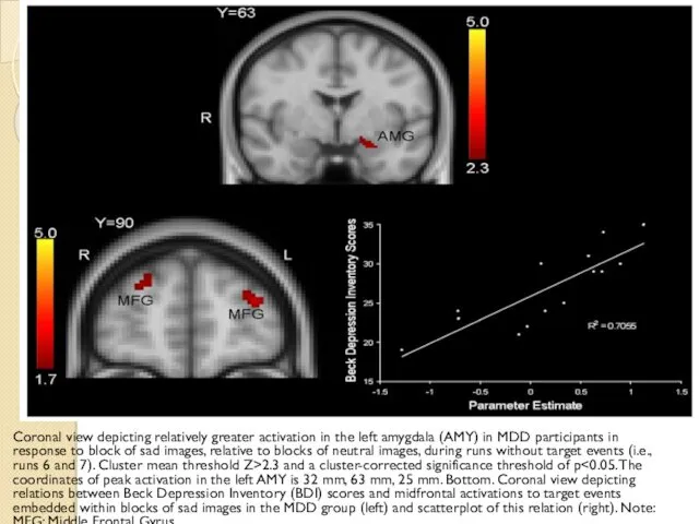 Coronal view depicting relatively greater activation in the left amygdala (AMY) in MDD