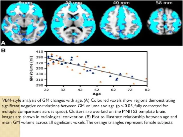 VBM-style analysis of GM changes with age. (A) Coloured voxels