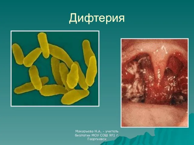 Макарьева Н.А. - учитель биологии МОУ СОШ №1 г.Георгиевск Дифтерия