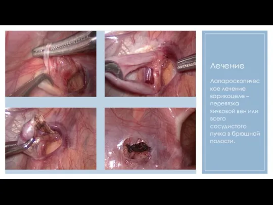 Лечение Лапароскопическое лечение варикоцеле – перевязка яичковой вен или всего сосудистого пучка в брюшной полости.