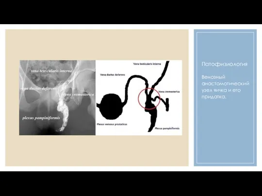 Патофизиология Венозный анастомотический узел яичка и его придатка.