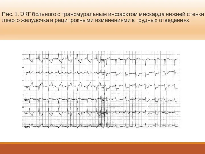 Рис. 1. ЭКГ больного с трансмуральным инфарктом миокарда нижней стенки