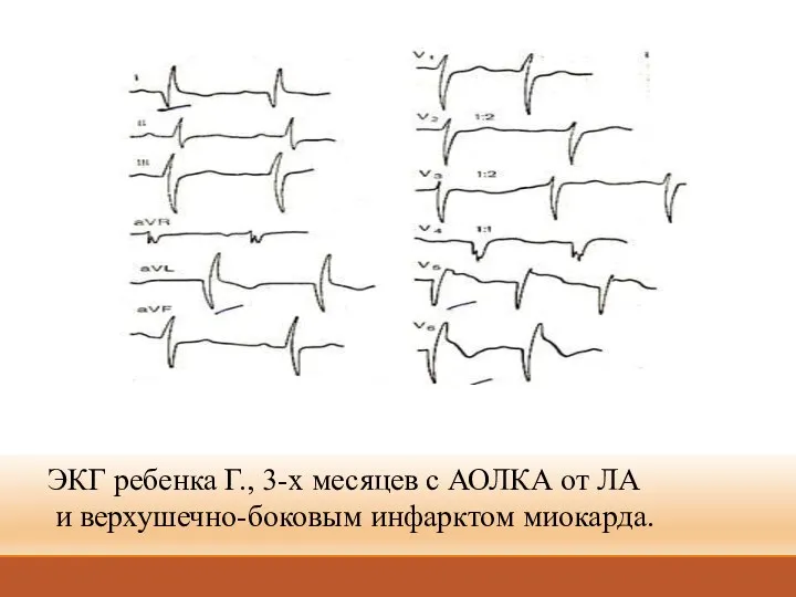 ЭКГ ребенка Г., 3-х месяцев с АОЛКА от ЛА и верхушечно-боковым инфарктом миокарда.