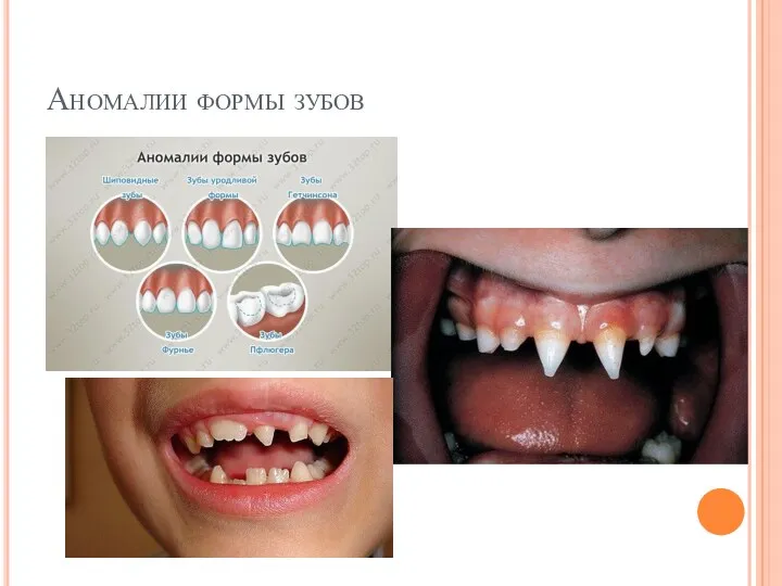 Аномалии формы зубов