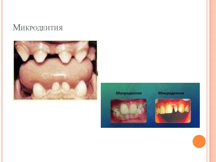 Микродентия