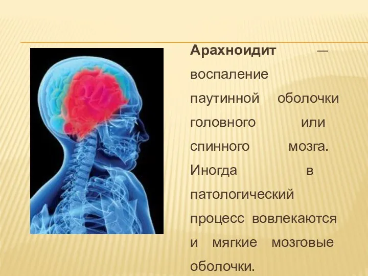 Арахноидит — воспаление паутинной оболочки головного или спинного мозга. Иногда