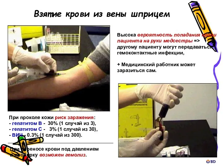 Взятие крови из вены шприцем Высока вероятность попадания крови пациента на руки медсестры