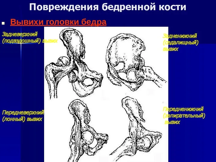 Повреждения бедренной кости Вывихи головки бедра Задневерхний (подвздошный) вывих Задненижний