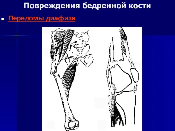 Повреждения бедренной кости Переломы диафиза