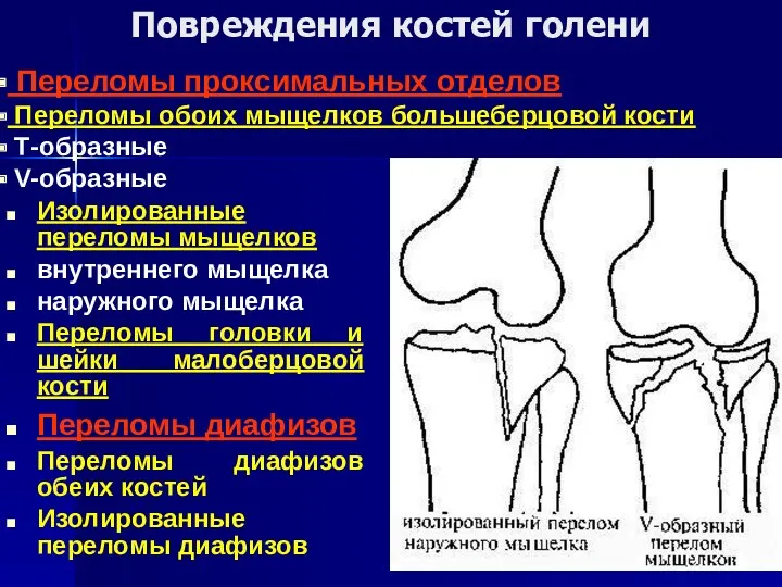 Повреждения костей голени Изолированные переломы мыщелков внутреннего мыщелка наружного мыщелка