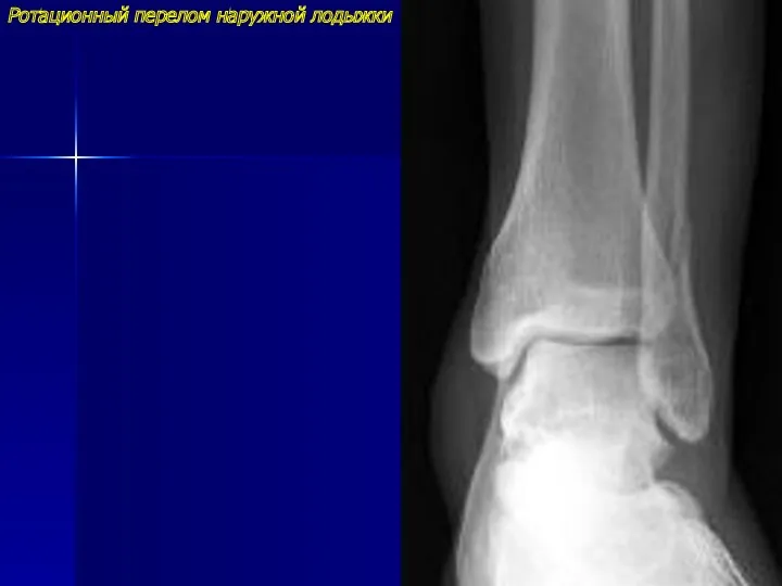 Ротационный перелом наружной лодыжки
